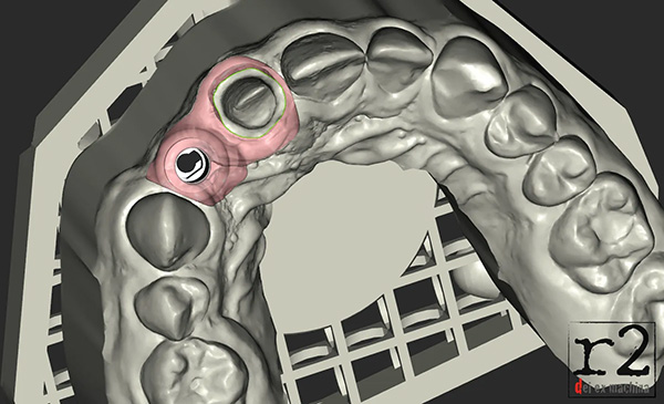 Zusatzmodul Implantate für Fix-it-Erik Modellsoftware - erhältlich bei GO3DENT