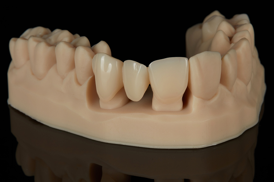 Formlabs BEGO TriniQ Resin – CE-zertifiziertes Material für temporäre Kronen und Brücken (nur Form 4B)